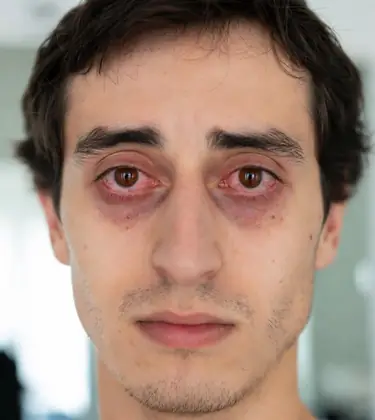 Weed Makes Eyes Red